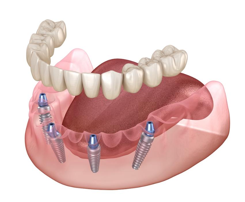 implant supported dentures