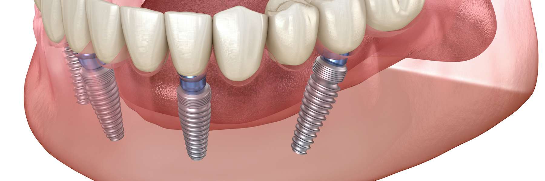 all on 4 implants