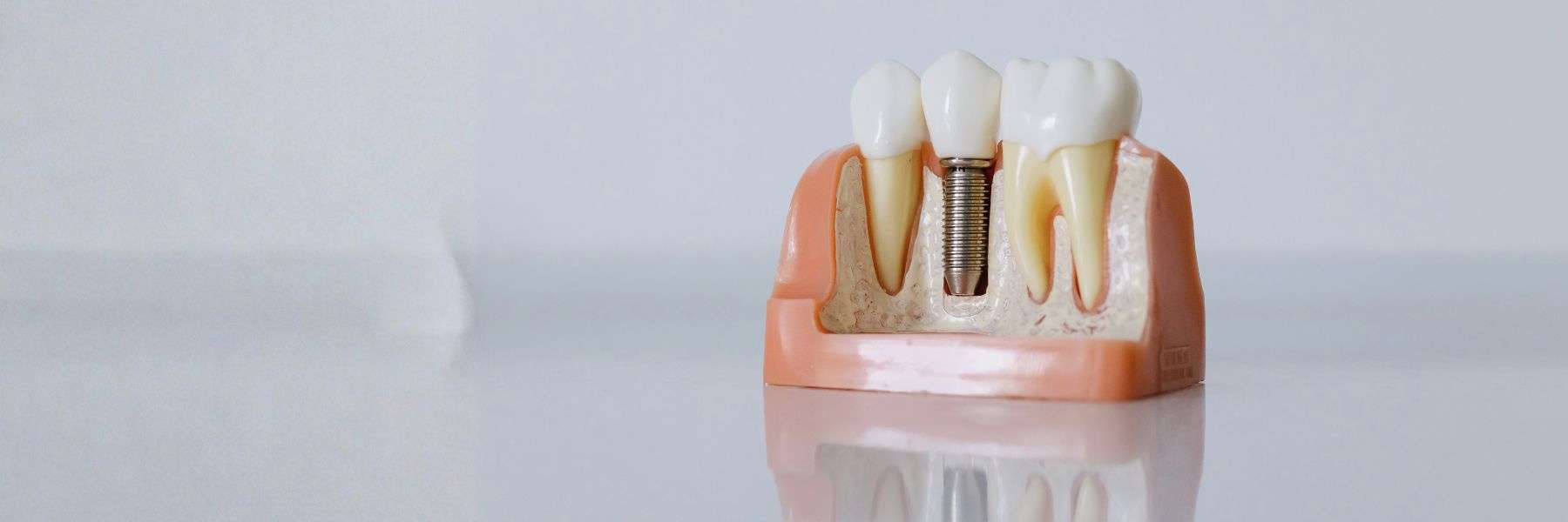 dental implant