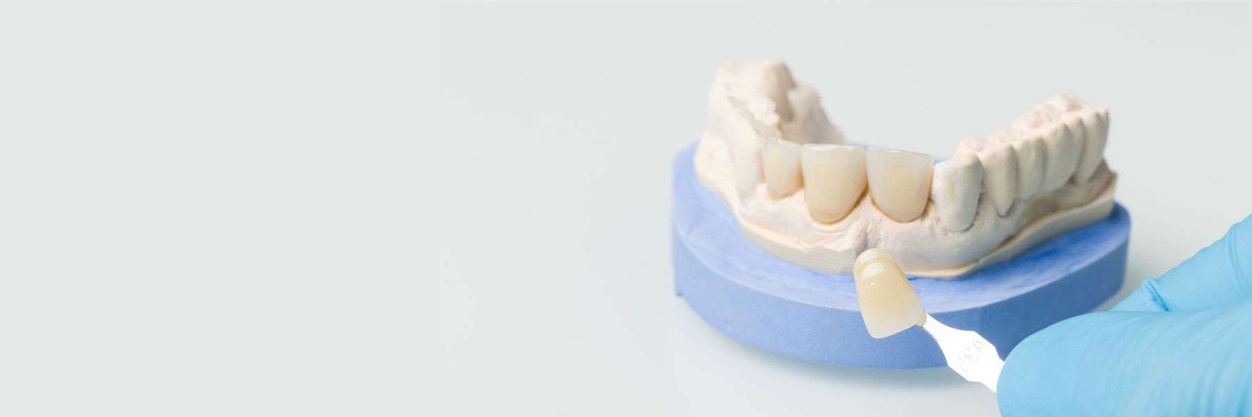 mold of teeth with an example of a veneer