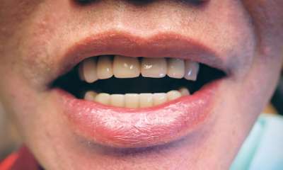 patient's smile after Front Bridge