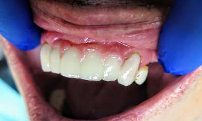 patient's smile after new Front Bridge