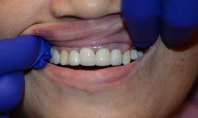 front teeth after Crowns
