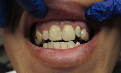 new tooth colored Front Fillings