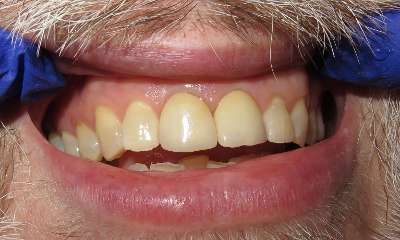 close up of client's smile after Front Veneers