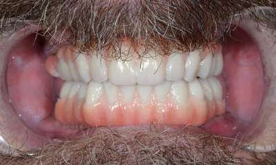 close up of smile after Full Arch Dental Implants