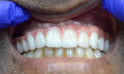 patient after Full Arch Dental Implants