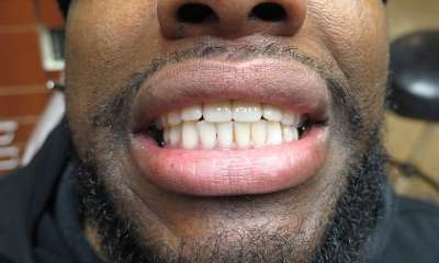 close up of patient's smile after implant bridge