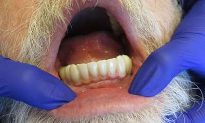 patient's bottom row of teeth after Implant Bridge