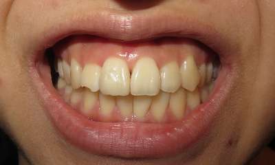 patient's teeth after orthodontics 