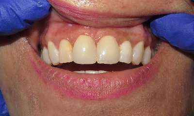 close up of patient's smile after veneers