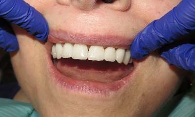 patient's bright smile after veneers