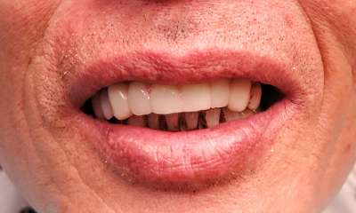 patient's smile after new front bridge