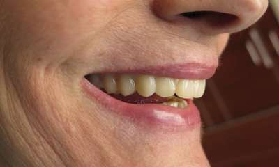 close up of patient's smile after Full Arch Dental Implants
