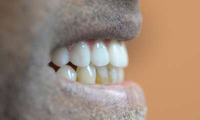 side profile of patient's smile after Full Arch Dental Implants