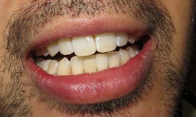 patient's smile after Front Implant