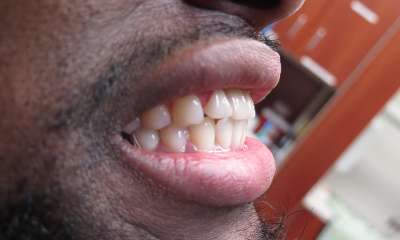 profile shot of patient's smile after implant bridge