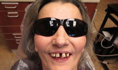 patient before Full Arch Dental Implants