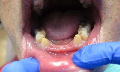 client's bottom jaw missing teeth before Front Bridge