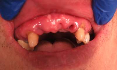 person missing top front teeth