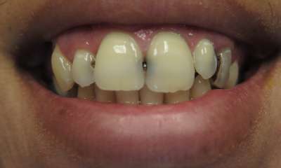 old discolored fillings on front teeth