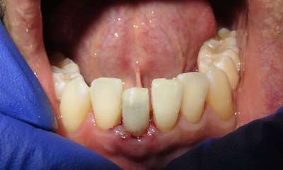 discolored tooth before implant