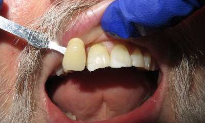 patient with uneven teeth before veneers