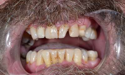 close up of smile before Full Arch Dental Implants