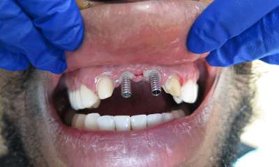 client with missing front teeth before implant bridge