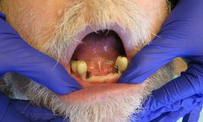 patient missing bottom front teeth before bridge