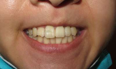 patient's teeth before orthodontics 