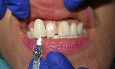 patient's smile before veneers
