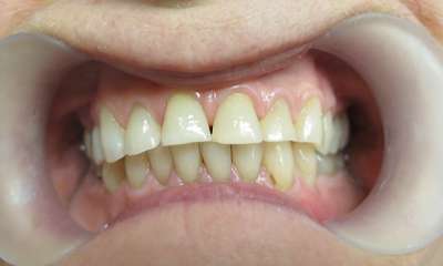 patient's smile before veneers