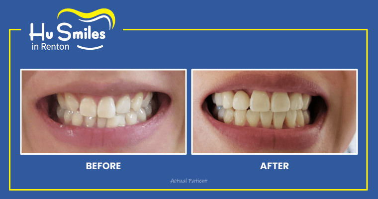 Patient's smile before and after Invisalign treatment.