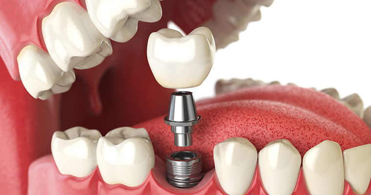 An exploded view of a dental implant in a mouth, showing all three parts.