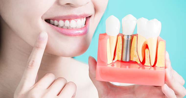 5 Dental Implant FAQs